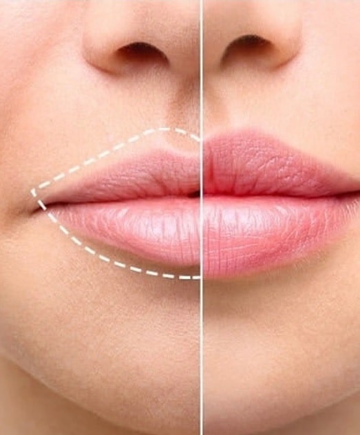 Traitement des lèvres sans injection, traitements esthétiques au laser, soins visage à Bordeaux